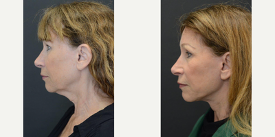 Lifestyle Lift before and after photo