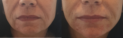 Voluma before and after photo