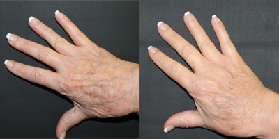 Hand Rejuvenation before and after photo