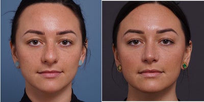 Rhinoplasty before and after photo