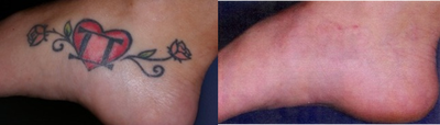 Tattoo Removal before and after photo