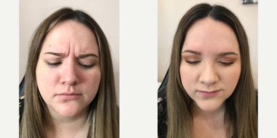 Botox before and after photo