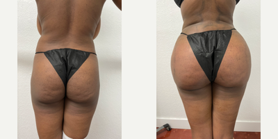 Brazilian Butt Lift before and after photo