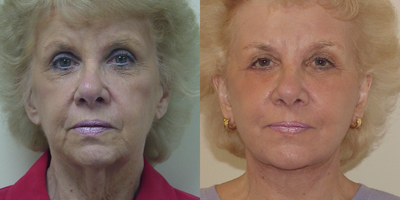 Eyelid Surgery before and after photo