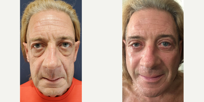 Facelift before and after photo
