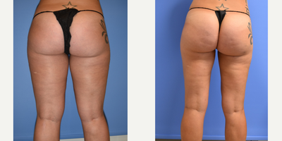 Liposuction before and after photo