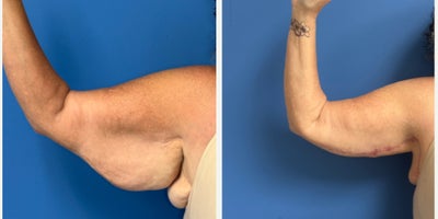 Arm Lift before and after photo