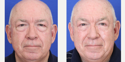 Double Eyelid Surgery before and after photo