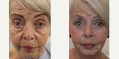 Eyelid Surgery before and after photo