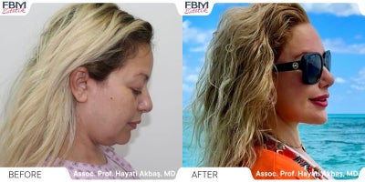 Eyelid Surgery before and after photo
