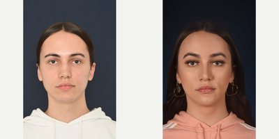 Facial Feminization Surgery before and after photo