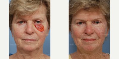 Facial Reconstructive Surgery before and after photo
