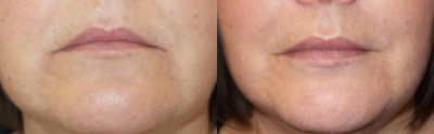 Lip Fillers before and after photo