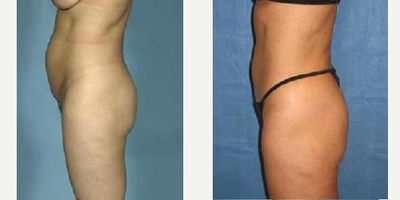 Liposuction before and after photo