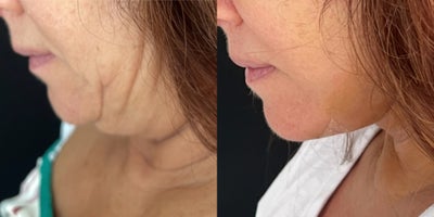 Facelift before and after photo