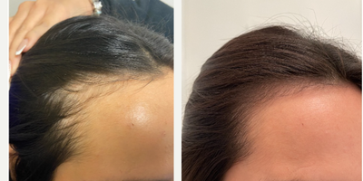 Hair Loss Treatment before and after photo