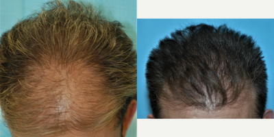 Hair Transplant before and after photo