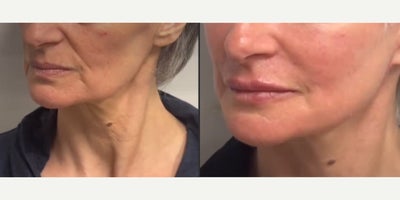 Neck Lift before and after photo