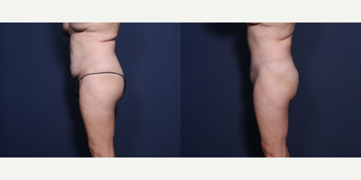 Tummy Tuck before and after photo