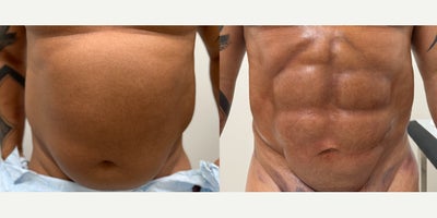 Abdominal Etching before and after photo