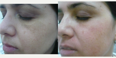 Chemical Peel before and after photo