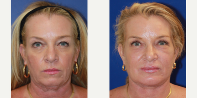 Eyelid Surgery before and after photo