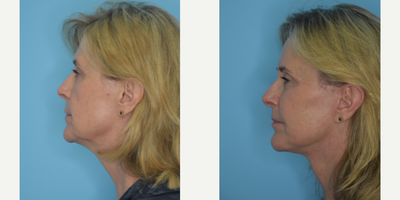 Lower Facelift before and after photo