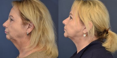 Neck Lift before and after photo