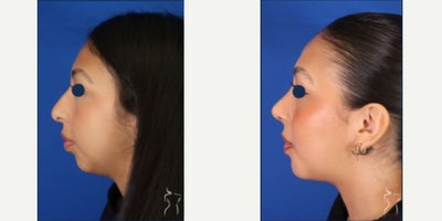 Rhinoplasty before and after photo