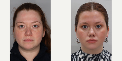 Vaser Liposuction before and after photo