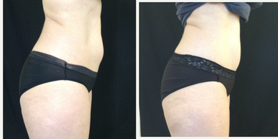 CoolSculpting before and after photo