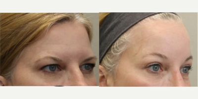 Eyelid Surgery before and after photo