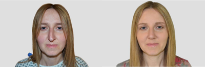 Rhinoplasty before and after photo