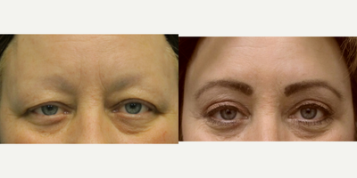 Brow Lift before and after photo