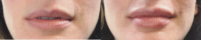 Dermal Fillers before and after photo