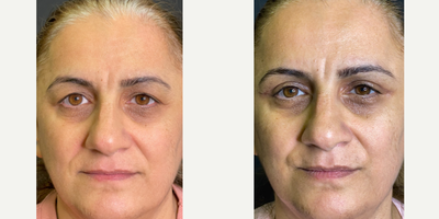 Eyelid Surgery before and after photo