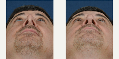 Revision Rhinoplasty before and after photo