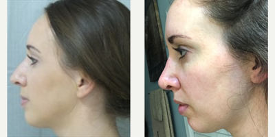 Rhinoplasty before and after photo
