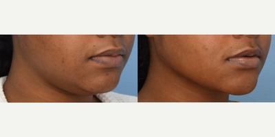 Chin Liposuction before and after photo