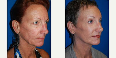 Facelift before and after photo