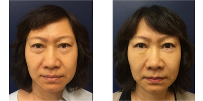 Facial Fat Transfer before and after photo