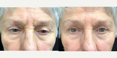 Ptosis Surgery before and after photo