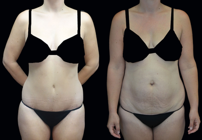 Tummy Tuck before and after photo