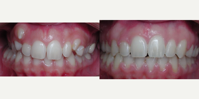 Braces before and after photo