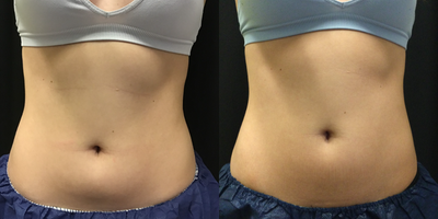 CoolSculpting before and after photo