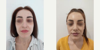 Rhinoplasty before and after photo