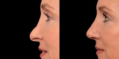 Rhinoplasty before and after photo