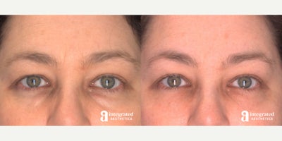 AccuTite before and after photo