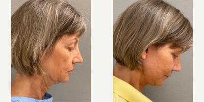 before and after image