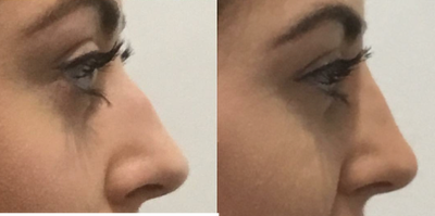 Nonsurgical Nose Job before and after photo